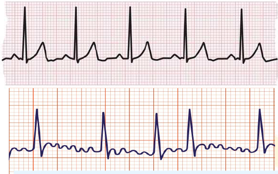 Arritmias / arrhythmia ECG